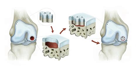 Osteochondral Grafts - Biocompatible Solutions for Cartilage Repair!